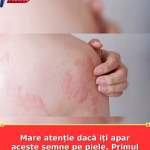 Mare atenție dacă iți apar aceste semne pe piele. Primul simptom este mâncărimea